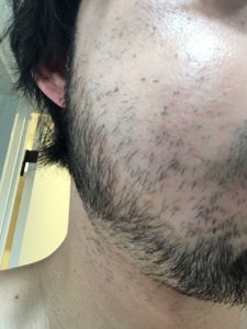 髭脱毛 始めて一年後の状態 福岡市博多区の男性専門美容室 Men S Hair Aratana