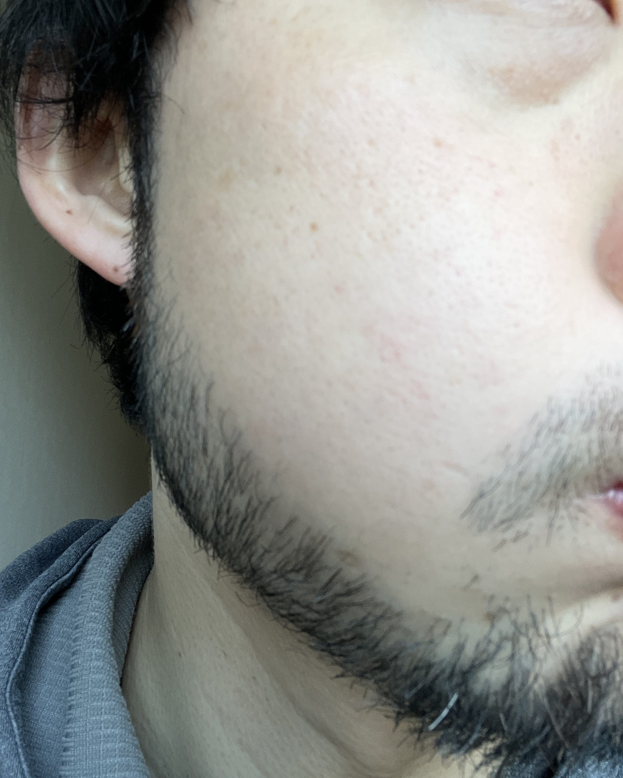 髭脱毛 始めて一年後の状態 福岡市博多区の男性専門美容室 Men S Hair Aratana